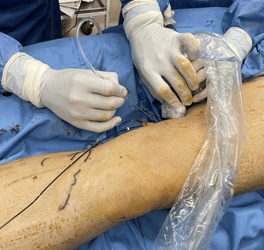 Cirugía vascular: descubre más sobre la Flebología - CDI